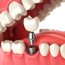 Diente Implante Clinica Dental Tridental Fuenlabrada
